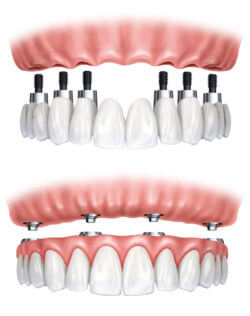 Bristol Cost of Dental Implants