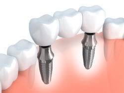 Dental Implants Practice Bristol